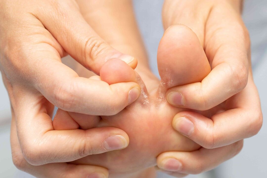 Mushroom between the toes and its treatment with ZXCVBNMQWert -cream