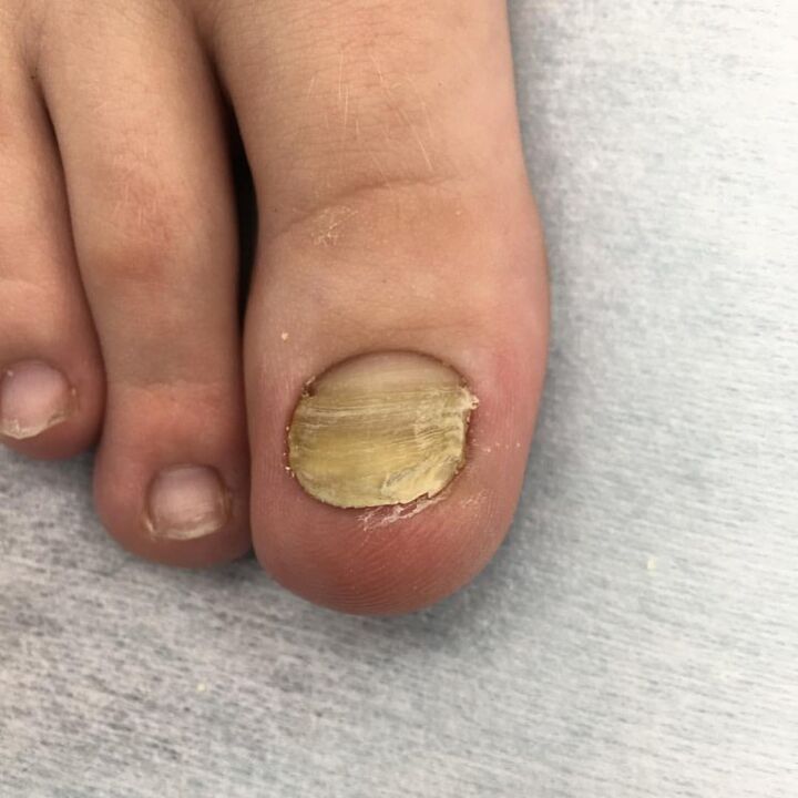 Infection with a mushroom
