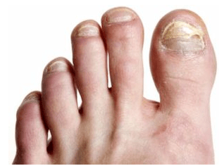 Nail fungus