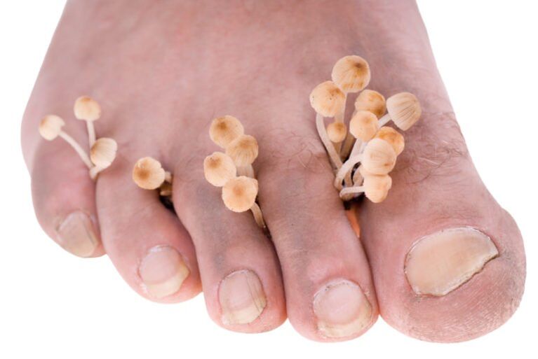 Mushroom over the legs symptoms