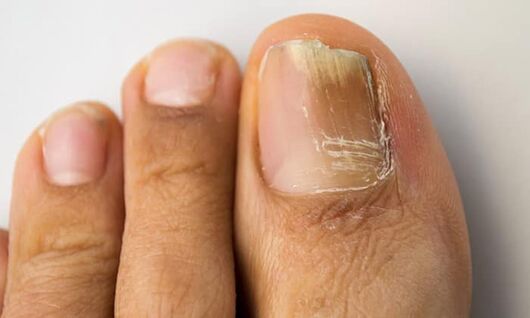 Distal-lateral damage to onychomycosis on the legs