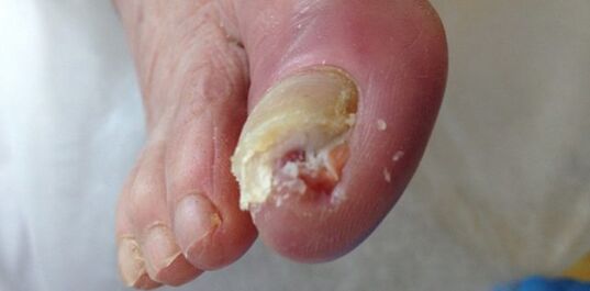 The reservoir and the source of dermatophytic mushrooms are a sick person