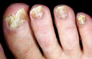 Symptoms of toenail fungus