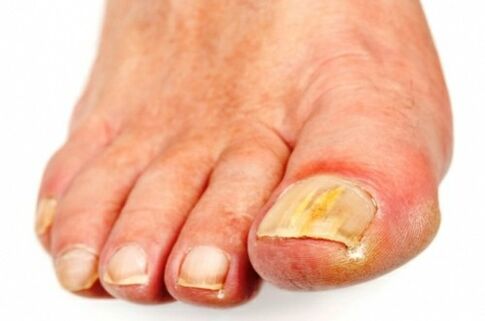 The fungus initially affects the nails of the first and fifth toes