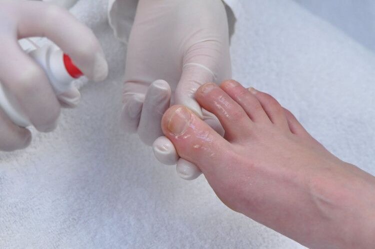 Treatment of the nail plate for fungal infections